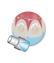 minimold cone orthodontie azur orthodontics
