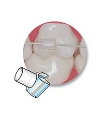 minimold tube orthodontie azur orthodontics