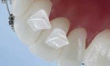presentation bite bumper orthodontie azur orthodontics