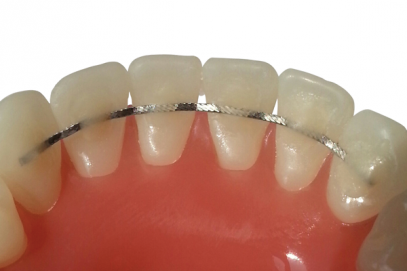 fil contention reliance orthodontic orthodontie azur orthodontics
