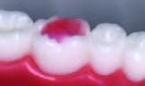 adhesif seringue tko buildup 2 orthodontie azur orthodontics