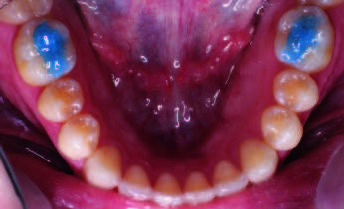 adhesif ultra band lok luer loc buildup dent orthodontie azur orthodontics