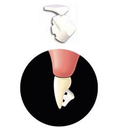 bite bumper etape 3 azur orthodontics