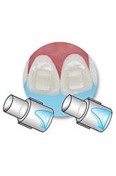 minimold bite rampe orthodontie azur orthodontics