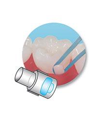 minimold bouton orthodontie azur orthodontics