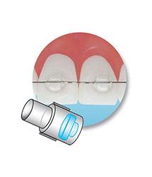 minimold bracket orthodontie azur orthodontics
