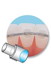 minimold plot contention orthodontie azur orthodontics
